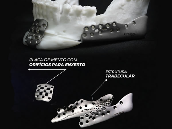 Ortognática Sob Medida - Mandibula